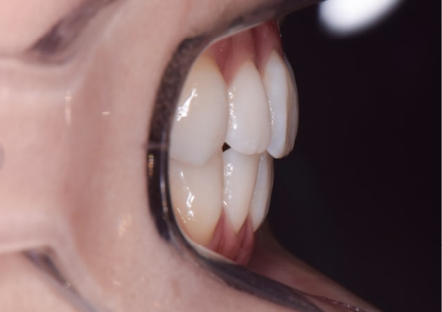 大阪の矯正歯科 淀屋橋矯正歯科 裏側矯正 治療後の真横から見た状態
