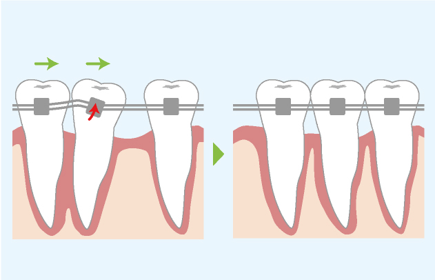 裏側矯正（舌側矯正）で歯が移動する仕組み