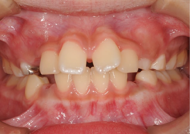 大阪 矯正歯科 淀屋橋矯正歯科 小児矯正 治療前の正面から見た状態
