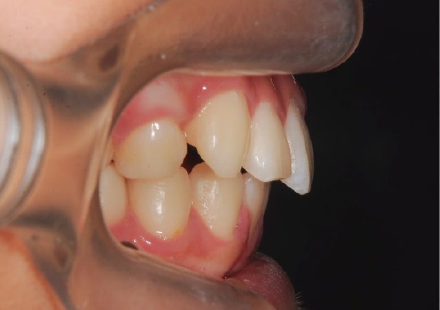 大阪 矯正歯科 淀屋橋矯正歯科 小児矯正 治療後の真横から見た状態