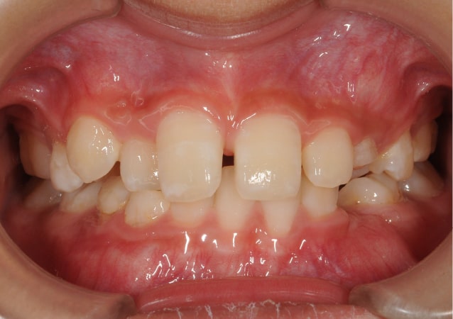 大阪 矯正歯科 淀屋橋矯正歯科 小児矯正 治療前の正面から見た状態