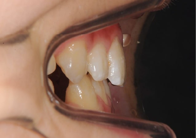 大阪 矯正歯科 淀屋橋矯正歯科 小児矯正 治療後の真横から見た状態