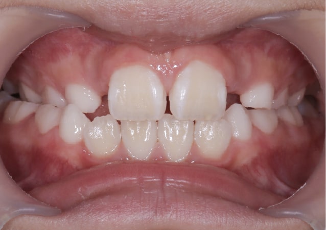 大阪の矯正歯科 淀屋橋矯正歯科 小児矯正 治療前の正面から見た状態
