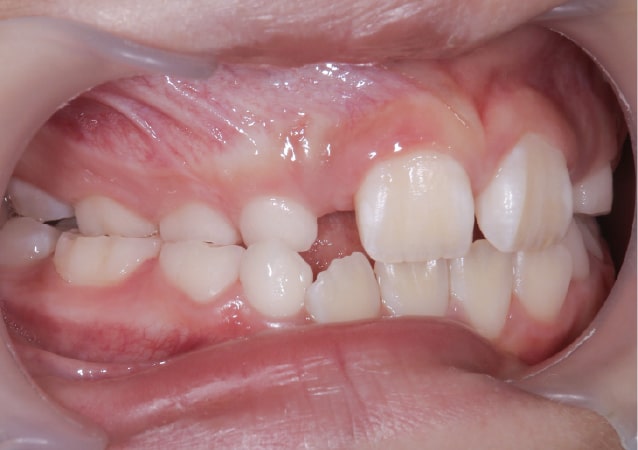 大阪の矯正歯科 淀屋橋矯正歯科 小児矯正 治療前の真横から見た状態