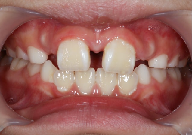 大阪 矯正歯科 淀屋橋矯正歯科 小児矯正 治療後の正面から見た状態